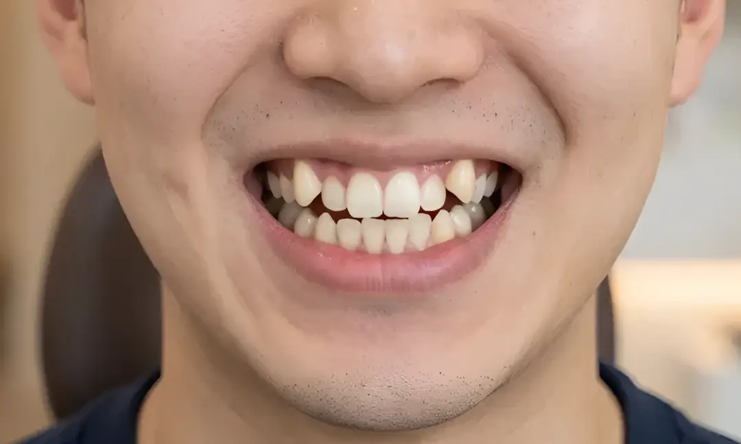 치아교정-덧니af